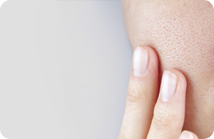 pores dilatés