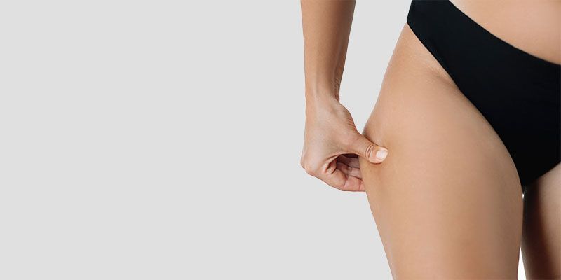 Le lifting latéral est conçu pour cibler spécifiquement le relâchement cutané situé à l'extérieur des cuisses.
