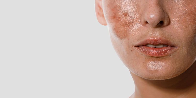 peeling-profond-au-phénol-corriger-cicatrices-taches-pigmentaires