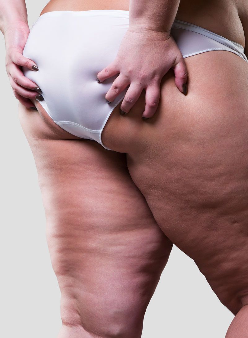 La liposuccion peut être utilisée pour soulager le lipoedème, en réduisant significativement des douleurs