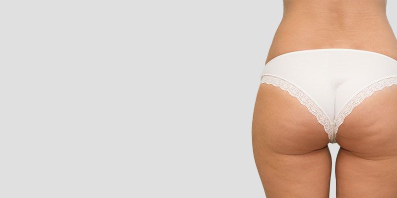 La liposuccion des fesses permet un contour des fesses plus harmonieux