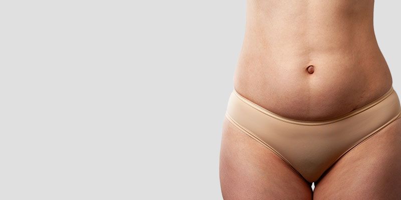 La liposuccion des hanches permet d’harmoniser les contours de la taille