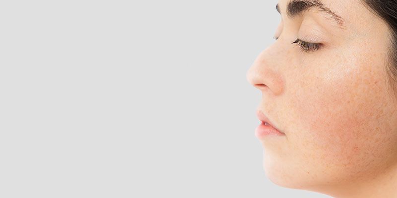 une rhinoplastie peut être appliquée pour réduction de la bosse nasale