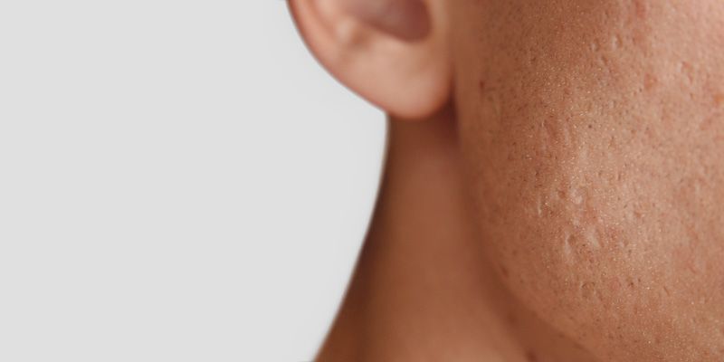 cicatrices-acne