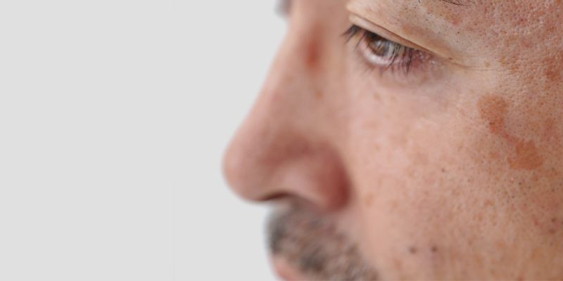 Tâches modéréessur le visage ou les zones exposées