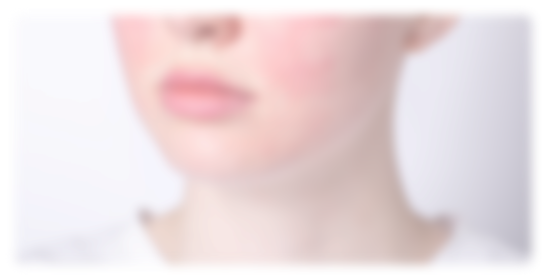 Couperose et Rougeurs