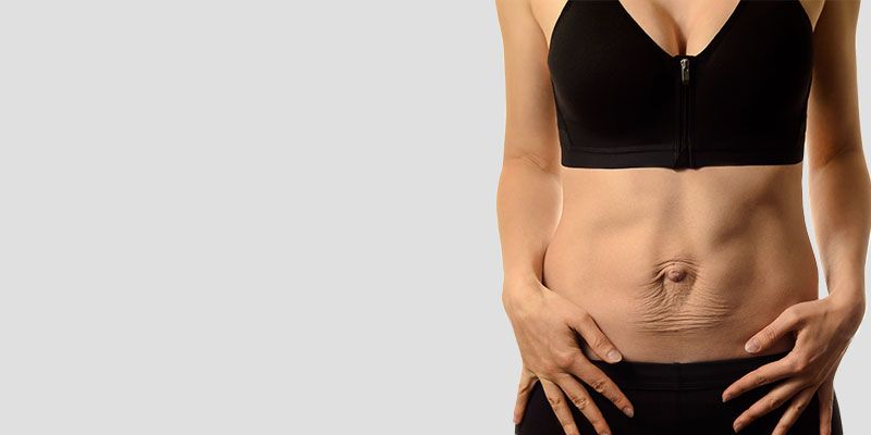 Correction du diastasis des muscles abdominaux, fréquente après une grossesse ou une perte de poids importante