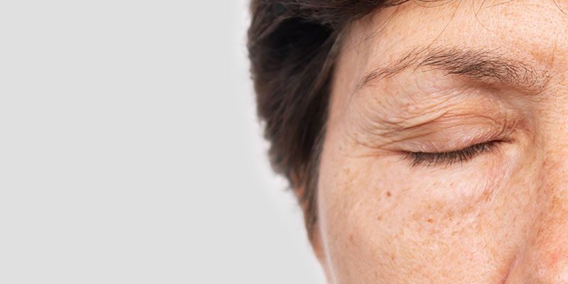 La blépharoplastie permet la correction des paupières tombantes