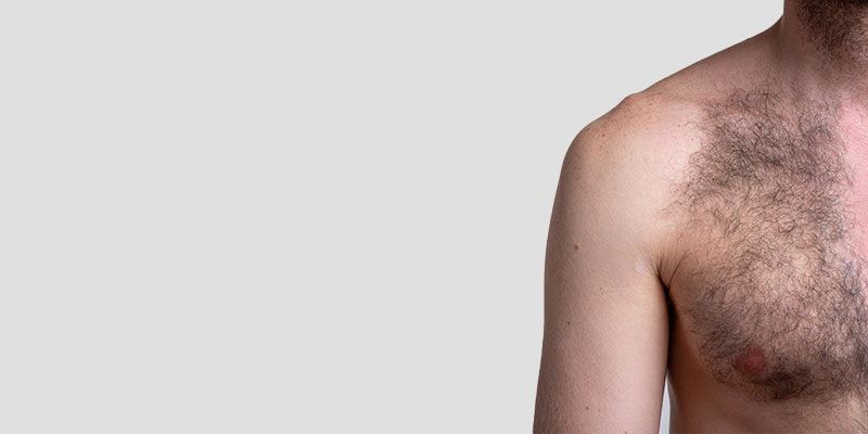 L'épilation laser réduit considérablement les poils épais de la poitrine et de l'abdomen, apportant un aspect soigné et propre
