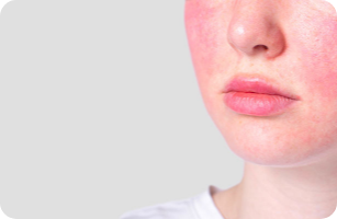 Rougeurs et couperoses sur le visage