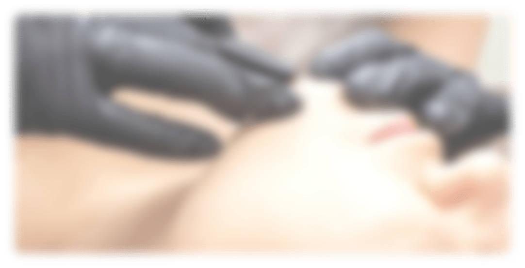 Épilation électrique haute fréquence Apilus à Paris 16