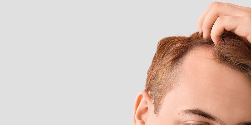 La mésothérapie offre une solution efficace pour traiter la perte de cheveux