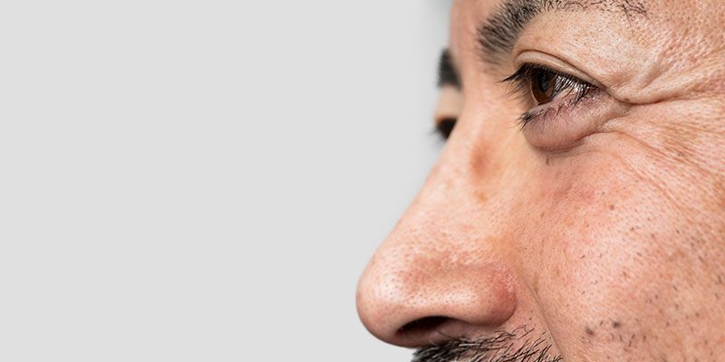 La blépharoplastie permet la traitement des poches sous les yeux