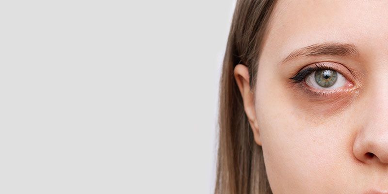 La blépharoplastie permet la réduction des cernes sous les yeux