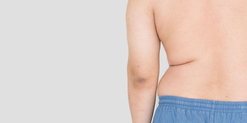 La liposuccion du dos permet de réduire efficacement la graisse dorsale