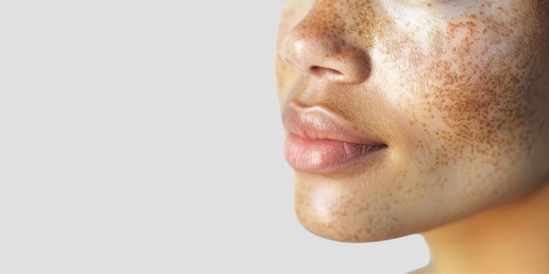 Le peeling TCA est utilisé pour réduire les tâches pigmentaires