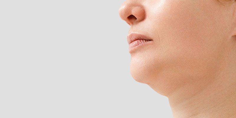La liposuccion du menton permet de réduire efficacement le double menton