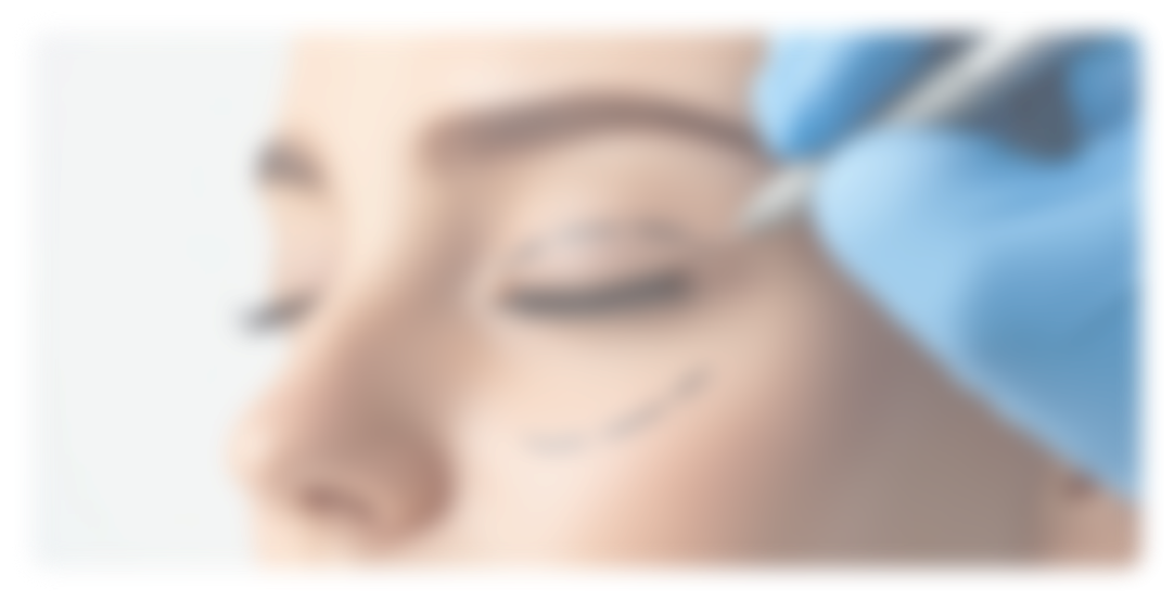 blepharoplastie paupiere tombante