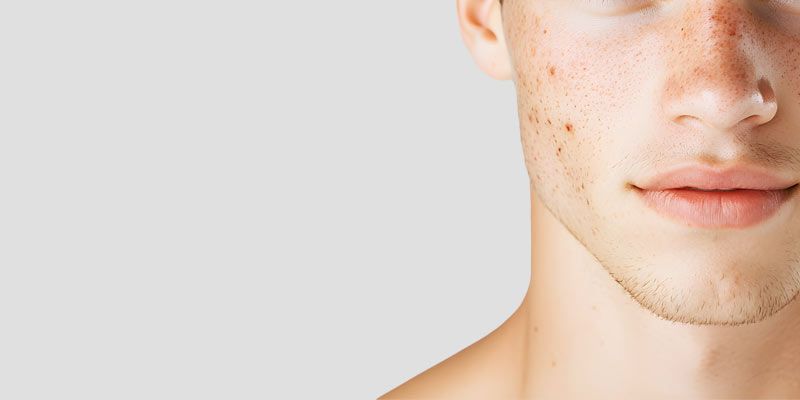 Le peeling du visage léger à l’acide glycolique ou lactique est utilisé améliorer les peaux à tendances acnéique