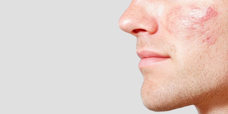 La mésothérapie est utilisée pour réduire les cicatrices