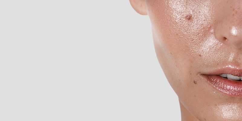 Le peeling TCA est utilisé pour réduire les pores dilatés